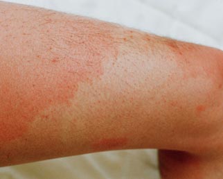 Red Leg